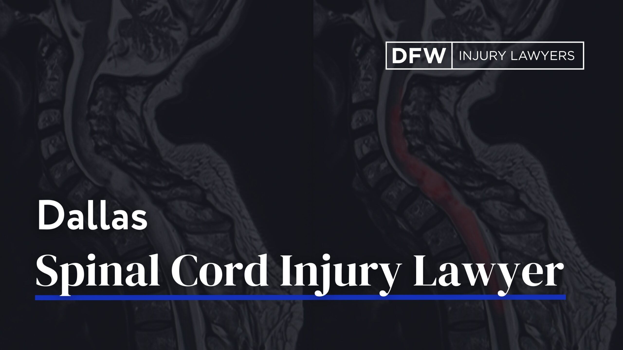 Dallas Spinal Cord Injury Lawyer - DFW